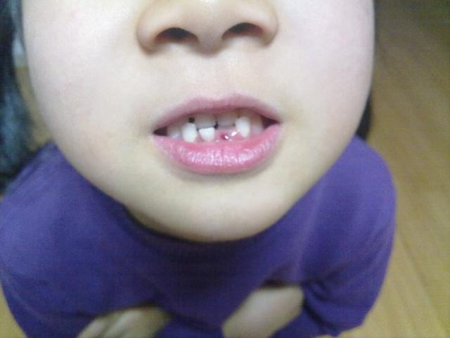 儿童长了双排牙怎么办（孩子长出双排牙）(1)